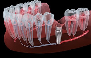 Illustration of placed dental implant in gum tissue