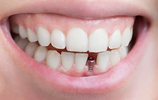 Smile with dental implant