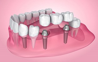 Exploded illustration of dental implants with bridge