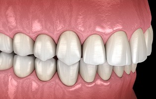 Illustration of an overbite