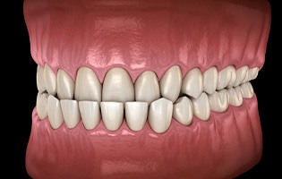 Illustration of an underbite