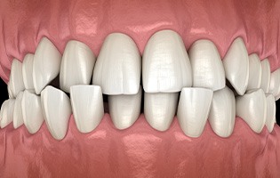 Illustration of a crossbite