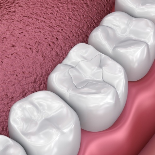 Animated close up of teeth with dental sealants