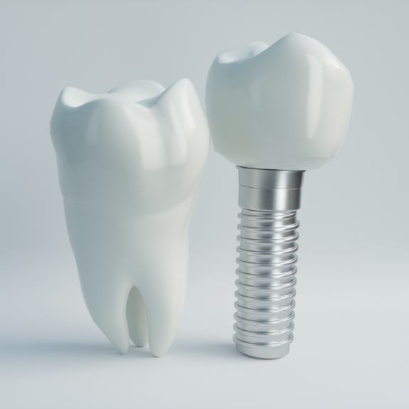 Model of natural tooth next to dental implant in Fair Oaks
