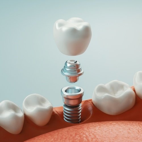 Animated dental implant with dental crown being placed in the jaw