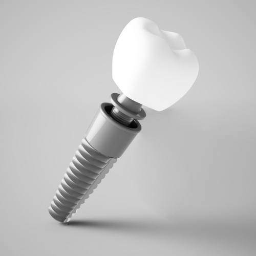 Model of dental implant with abutment and dental crown