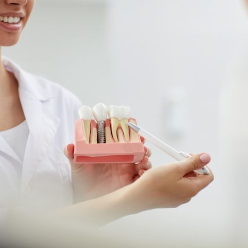 Dentist pointing to dental implant model