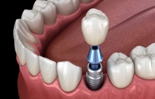 Animated dental crown being placed onto a dental implant