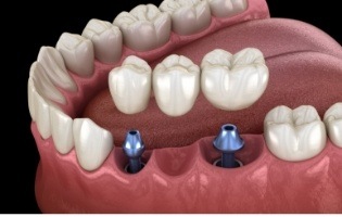 Animated dental bridge being placed onto two dental implants