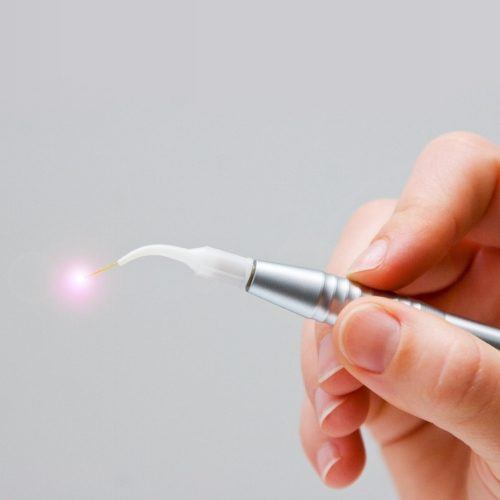 Hand holding a soft tissue laser dentistry tool