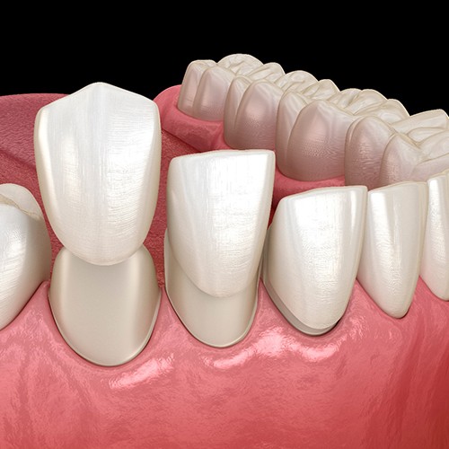 Two animated veneers being placed over front teeth
