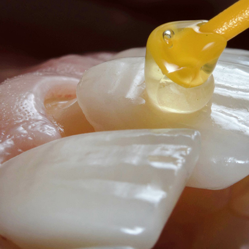 a closeup of a veneer being placed on a tooth