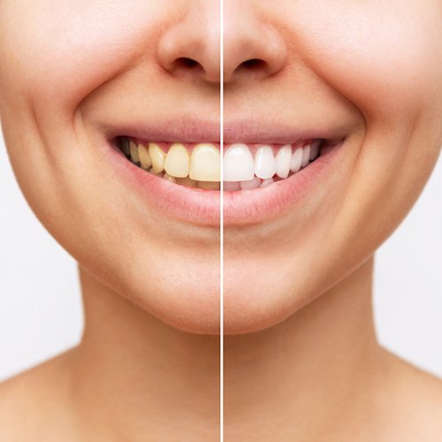 Woman’s smile before and after teeth whitening