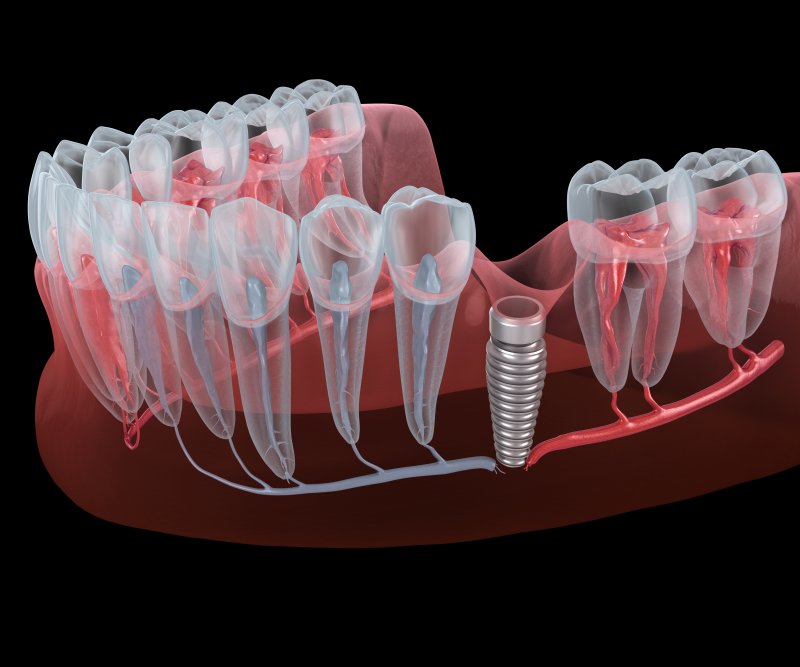 Illustration of implant placed in gum tissue