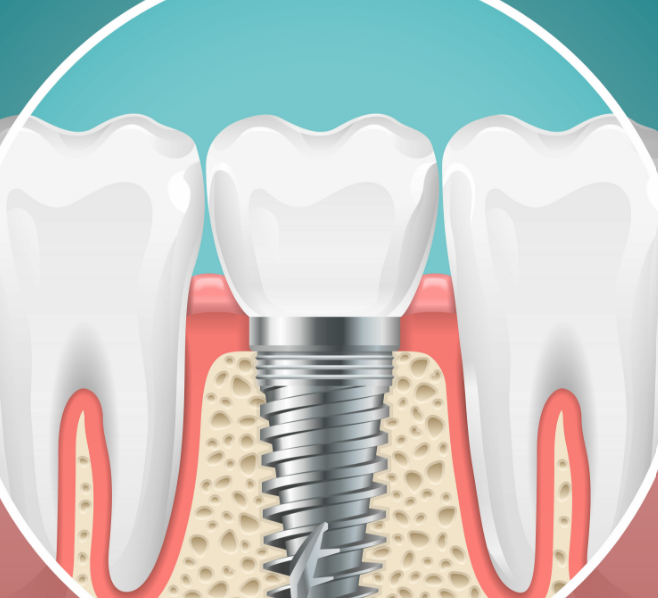 Dental implant illustration