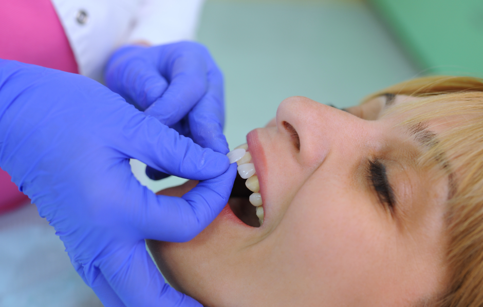 Patient being fitted for veneers