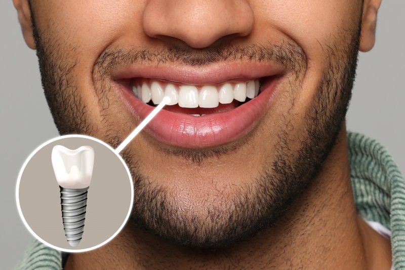 A photo highlighting a smiling, bearded man’s dental implant
